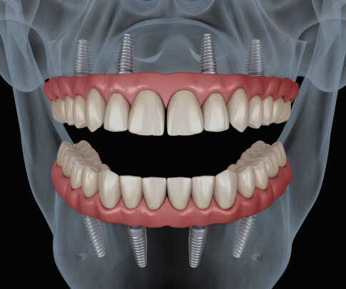 full arch restoration