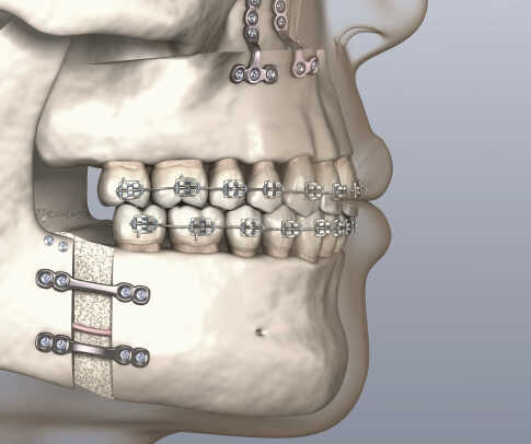orthognathic surgery