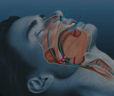 sleep apnea